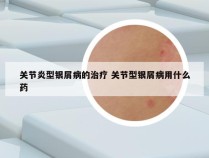 关节炎型银屑病的治疗 关节型银屑病用什么药