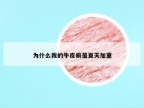 为什么我的牛皮癣是夏天加重