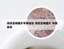 线状苔癣图片早期症状 线状苔癣图片 早期症状