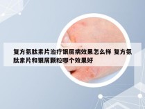 复方氨肽素片治疗银屑病效果怎么样 复方氨肽素片和银屑颗粒哪个效果好