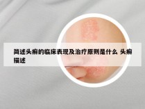 简述头癣的临床表现及治疗原则是什么 头癣描述