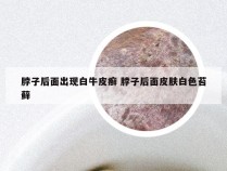 脖子后面出现白牛皮癣 脖子后面皮肤白色苔藓