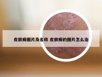 皮肤癣图片及名称 皮肤癣的图片怎么治