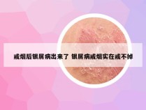 戒烟后银屑病出来了 银屑病戒烟实在戒不掉