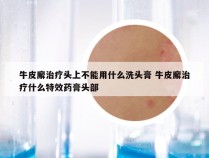 牛皮廨治疗头上不能用什么洗头膏 牛皮廨治疗什么特效药膏头部