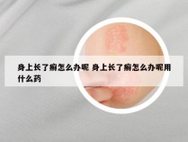 身上长了癣怎么办呢 身上长了癣怎么办呢用什么药