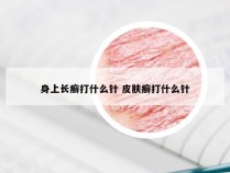 身上长癣打什么针 皮肤癣打什么针