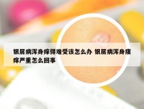 银屑病浑身痒得难受该怎么办 银屑病浑身瘙痒严重怎么回事