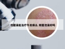 泡醋澡能治疗牛皮癣么 用醋泡澡好吗