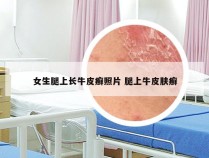 女生腿上长牛皮癣照片 腿上牛皮肤癣