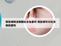 银屑病喝消银颗粒会加重吗 银屑病可以吃消银胶囊吗