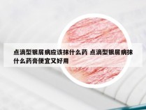 点滴型银屑病应该抹什么药 点滴型银屑病抹什么药膏便宜又好用