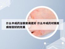 什么中成药治银屑病更好 什么中成药对银屑病有较好的效果