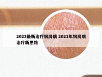 2023最新治疗银屑病 2021年银屑病治疗新思路