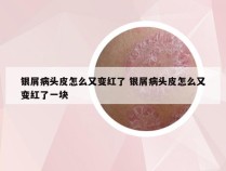 银屑病头皮怎么又变红了 银屑病头皮怎么又变红了一块