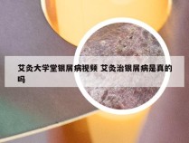 艾灸大学堂银屑病视频 艾灸治银屑病是真的吗