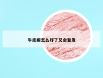 牛皮癣怎么好了又会复发