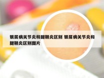 银屑病关节炎和腱鞘炎区别 银屑病关节炎和腱鞘炎区别图片