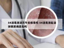 84消毒液消灭牛皮癣毒吗 84消毒液能涂抹银屑病患处吗