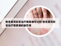 他克莫司软膏治疗银屑病可以吗 他克莫司软膏治疗银屑病的副作用