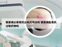 银屑病止痒用抗过敏药可以吗 银屑病能用抗过敏药物吗