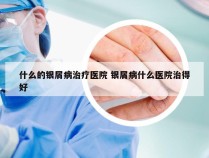 什么的银屑病治疗医院 银屑病什么医院治得好