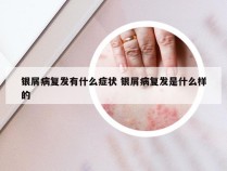 银屑病复发有什么症状 银屑病复发是什么样的