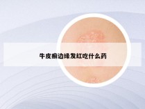 牛皮癣边缘发红吃什么药