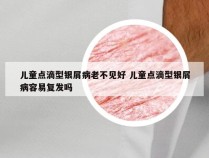 儿童点滴型银屑病老不见好 儿童点滴型银屑病容易复发吗