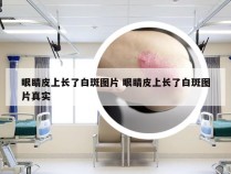 眼睛皮上长了白斑图片 眼睛皮上长了白斑图片真实