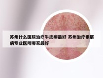 苏州什么医院治疗牛皮癣最好 苏州治疗银屑病专业医院哪家最好