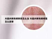 大腿内侧有癣刺挠怎么治 大腿内侧有癣痒是怎么回事