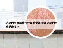 大腿内侧皮肤癣用什么药膏好得快 大腿内侧皮肤癣治疗