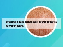 石家庄哪个医院看牛皮癣好 石家庄有专门治疗牛皮的医院吗