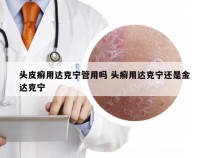 头皮癣用达克宁管用吗 头癣用达克宁还是金达克宁