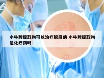 小牛脾提取物可以治疗银屑病 小牛脾提取物是化疗药吗