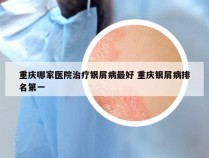 重庆哪家医院治疗银屑病最好 重庆银屑病排名第一