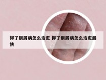 得了银屑病怎么治愈 得了银屑病怎么治愈最快