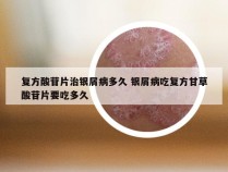 复方酸苷片治银屑病多久 银屑病吃复方甘草酸苷片要吃多久