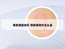 银屑病退烧药 银屑病发热怎么退