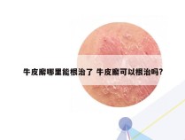 牛皮廨哪里能根治了 牛皮廨可以根治吗?