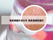 银屑病图片杏叶片 银屑病病型图片