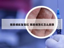 银屑病反复变红 银屑病发红怎么回事