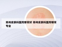 郑州皮肤科医院那家好 郑州皮肤科医院哪家专业