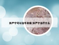 扶严宁可以治牛皮癣 扶严宁治疗什么