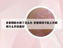 青春期脸长癣了怎么办 青春期孩子脸上长癣用什么药膏最好