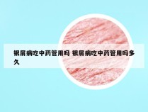 银屑病吃中药管用吗 银屑病吃中药管用吗多久