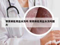 银屑癣能用盐水洗吗 银屑癣能用盐水洗吗图片