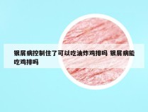 银屑病控制住了可以吃油炸鸡排吗 银屑病能吃鸡排吗