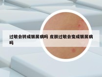 过敏会转成银屑病吗 皮肤过敏会变成银屑病吗